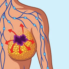 स्तन क्यान्सरको पहिलो डाक्टर तपाईं आफैं, थाहा पाउनुस् यसका सत्य र भ्रम